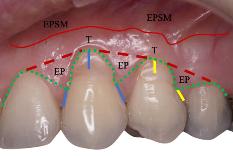 Complications Et Checs En Chirurgie Plastique Parodontale