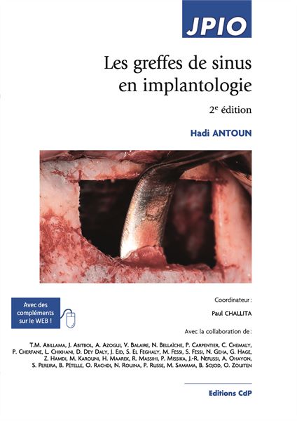 Les greffes de sinus en implantologie